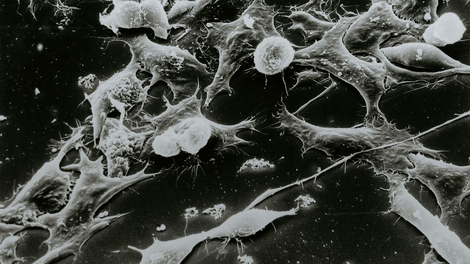 Scanning electron micrograph displaying irregular tumor cells spreading and interacting.