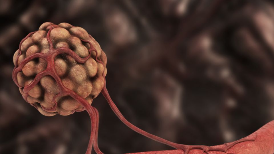 Render of an irregular tumor mass, surrounding by blood vessels stemming from one larger vessel.