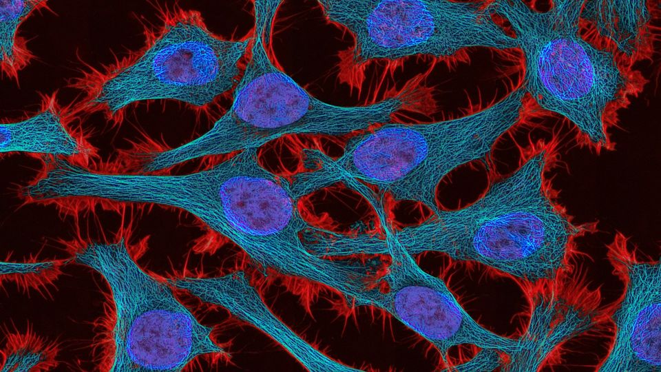 Fluorescent microscope image of cervical cancer cells.