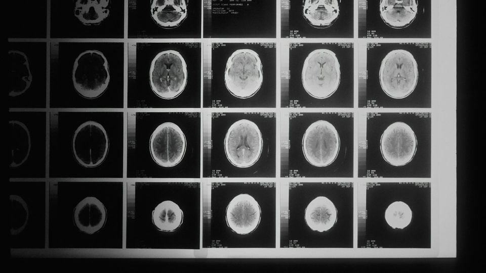 MRI scan showing multiple cross-sectional images of the brain.