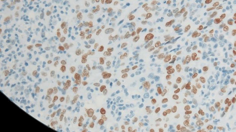 Microscopic image showing BRCA2 pathogenic variant staining in tissue cells.