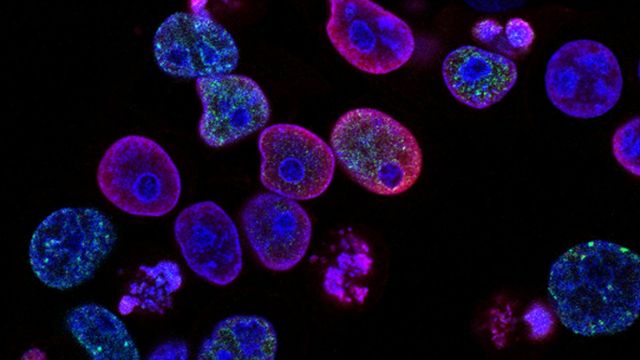 Fluorescent microscopy image of cancer cells with stained nuclei. 
