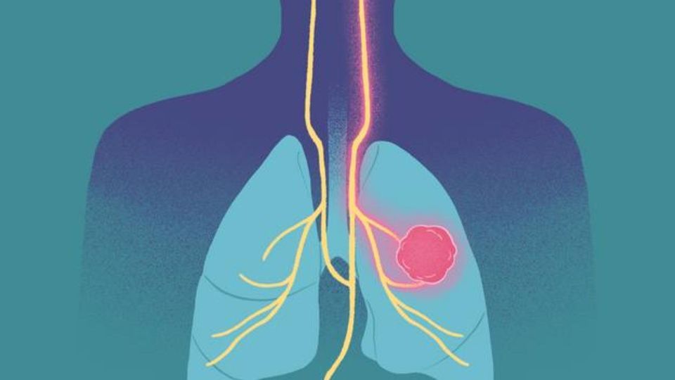 Illustration of lungs with a highlighted lung tumor, connecting to the brain.