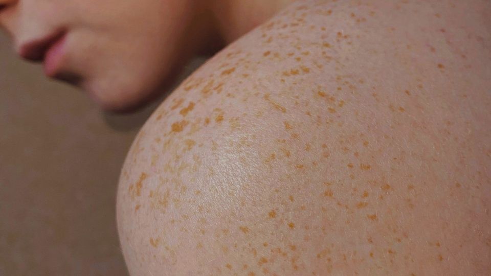 Close-up of skin freckles across a person's shoulder.