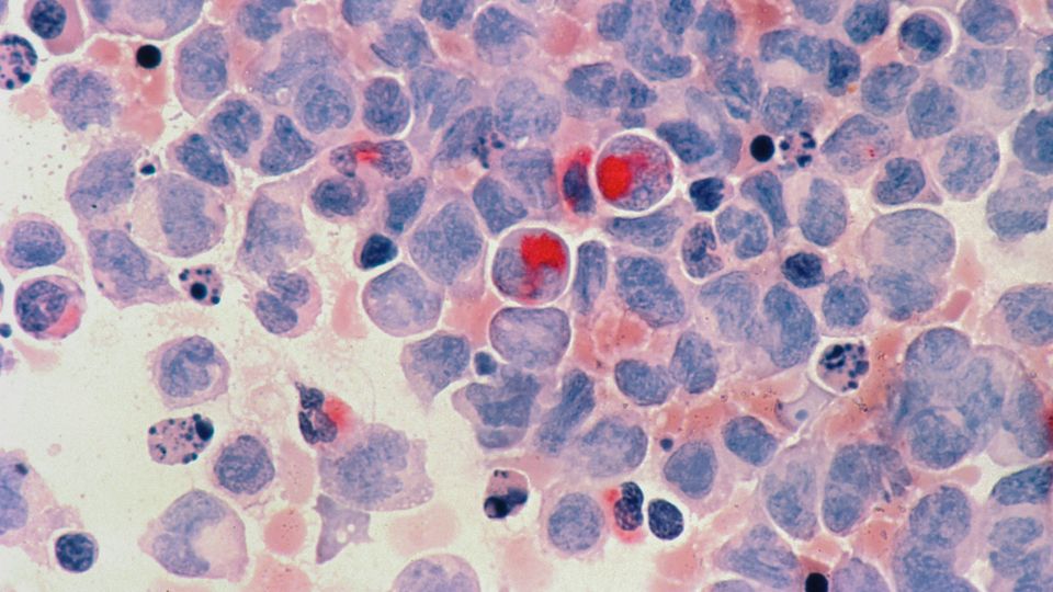 Acute myeloid leukemia cells viewed under a microscope.