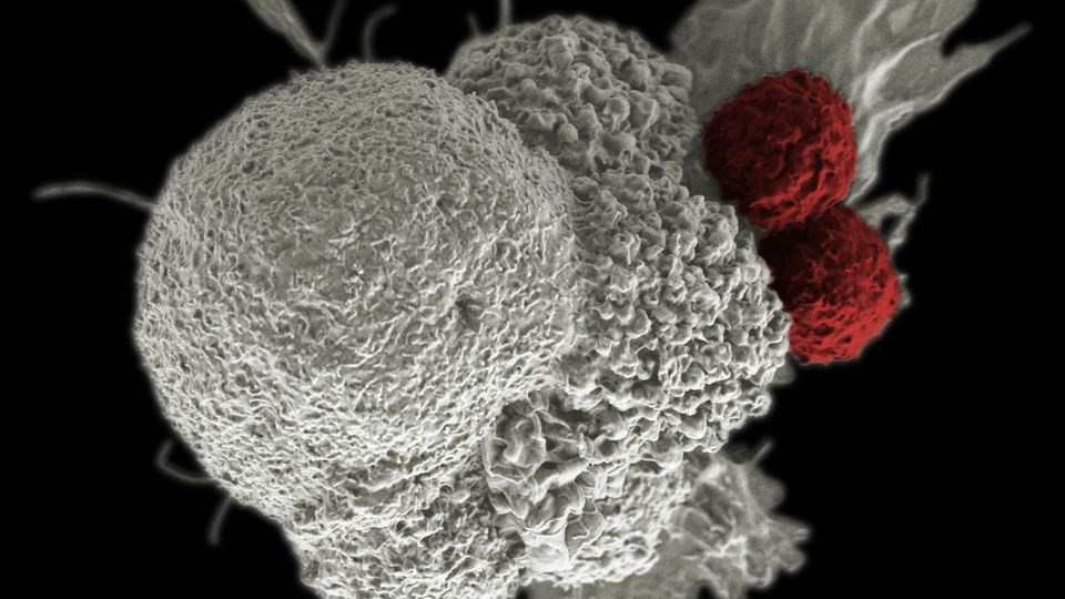 Scanning electron microscope image of cancer cells interacting with immune cells.