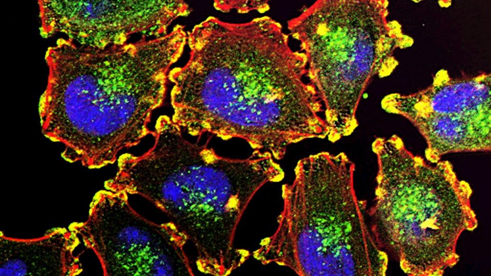 Fluorescence microscope image of metastatic melanoma cells.