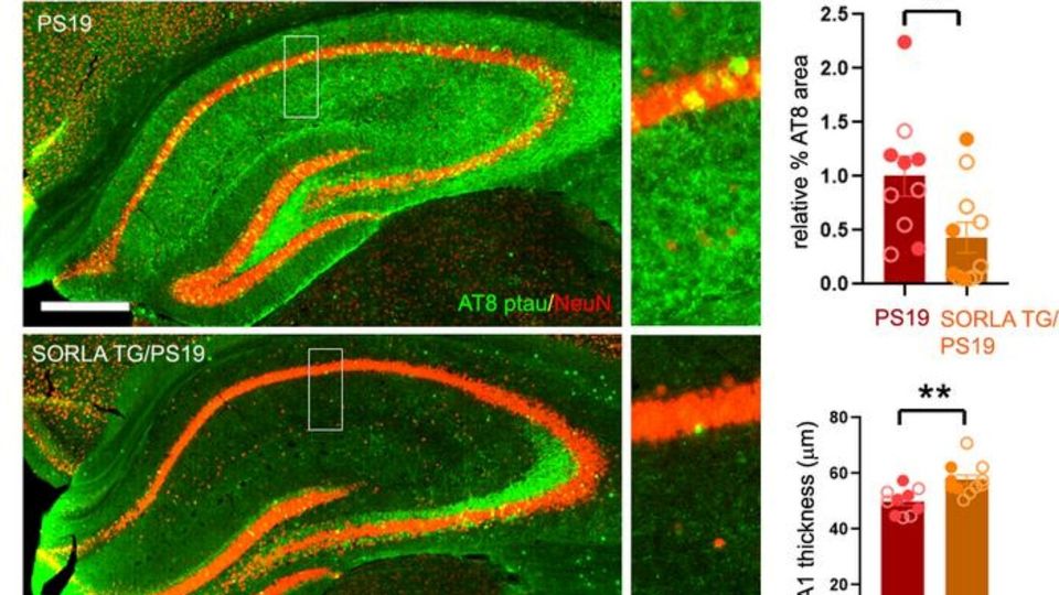 Fluorescent microscopy images comparing SORLA protein expression and tau pathology in brain tissue with quantitative analysis graphs.