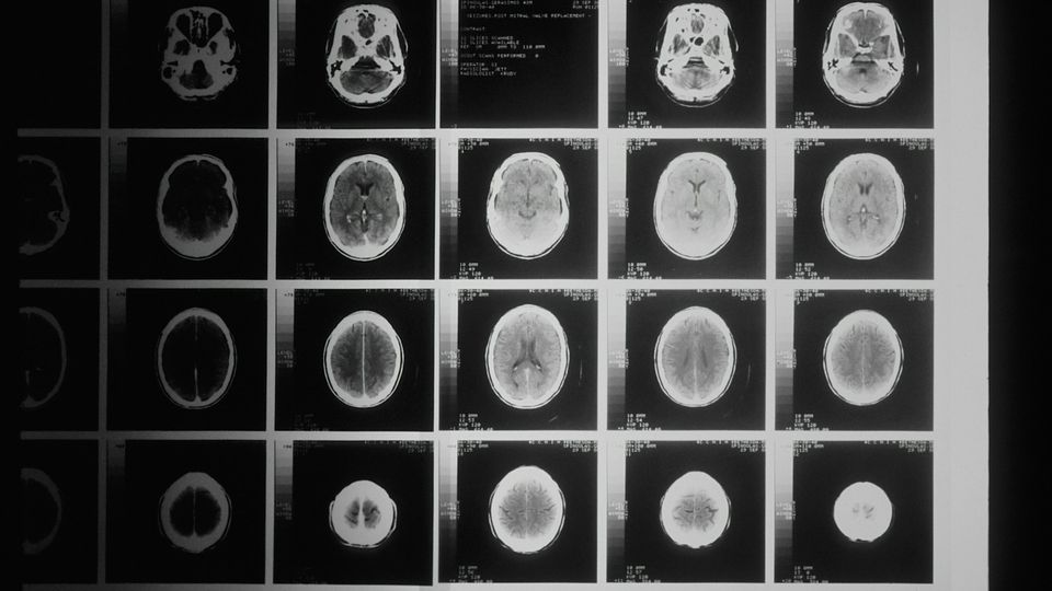 Grid of MRI scan displaying multiple cross-sectional brain views in black and white.