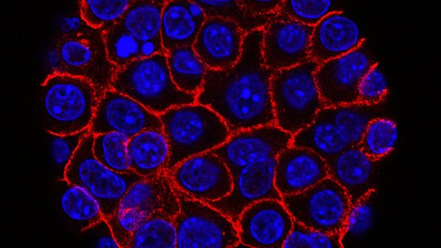 Fluorescent microscope image of cancer cells with blue nuclei and red cell membranes. 