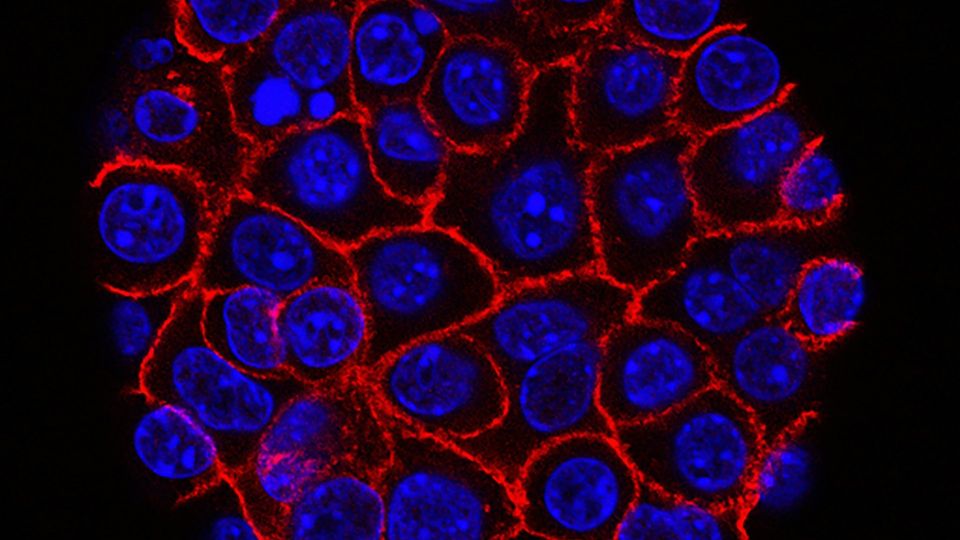 Fluorescent microscope image of cancer cells with blue nuclei and red cell membranes.