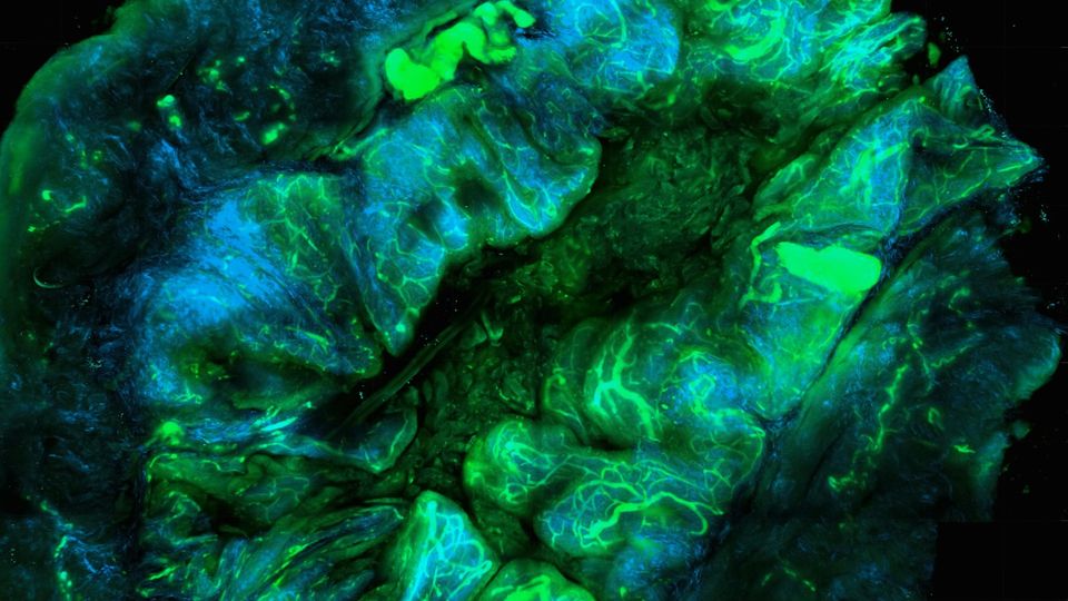 Fluorescent image of an ovarian tumor.