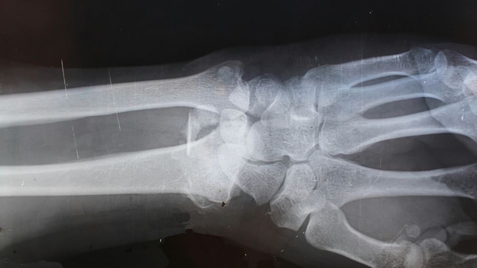 Black and white X-ray of a wrist, showing the forearm, carpal, and metacarpal bones. 