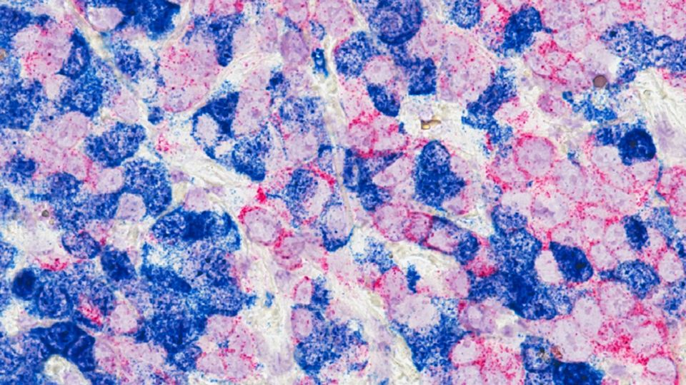 Microscopic image of stained breast cancer cells in pink and blue.