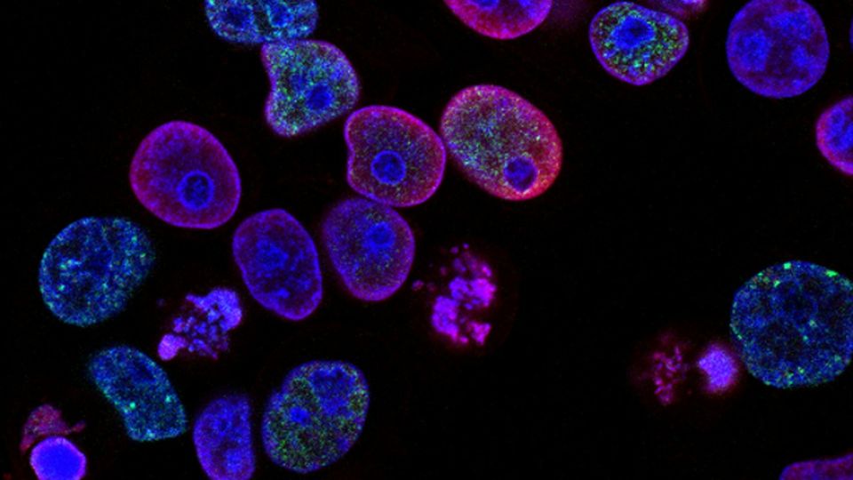 Fluorescent microscope image of cancer cells with stained nuclei and cellular structures.