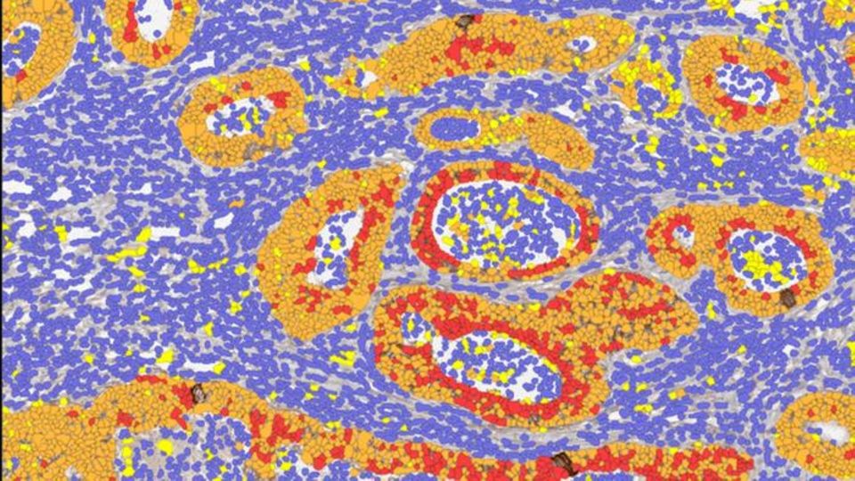 Colored microscope image of colorectal cancer cells showing tumor tissue structure and cellular organization.
