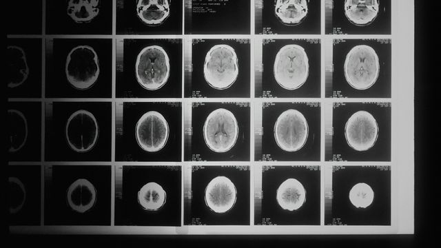 Series of brain scan images displayed for neurological diagnosis. 