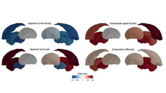 Brain MRI analysis showing color-coded maps of apparent soma density, soma size, and extracellular properties. 