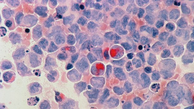 New Leukemia Target Kills Cancer Cells While Sparing Healthy Blood Cells
