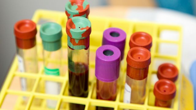 Blood sample tubes in a laboratory rack for medical testing. 
