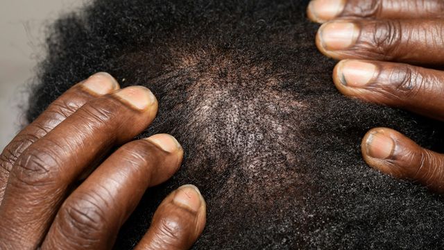 Close-up of a person's scalp showing hair loss with a visible bald spot. 