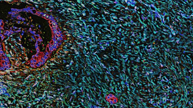 Section of pancreatic tissue showing cells and pancreatic desmoplasia. 