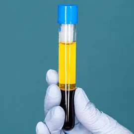 A glove hand holding a tube filled with a yellow and black liquid with a blue cap on a turquoise background.
