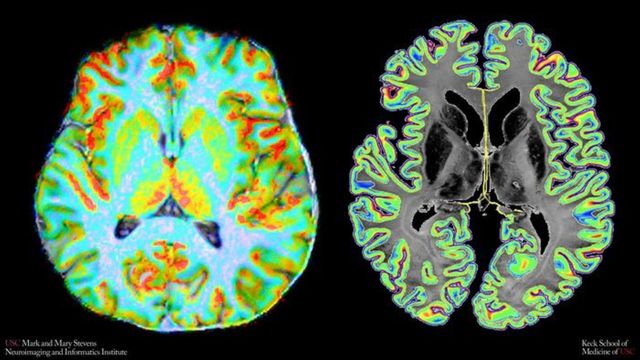 Brain blood flow shown in colorful functional brain imaging scans. 