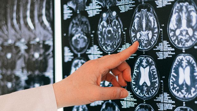 A clinician points to a brain scan. 