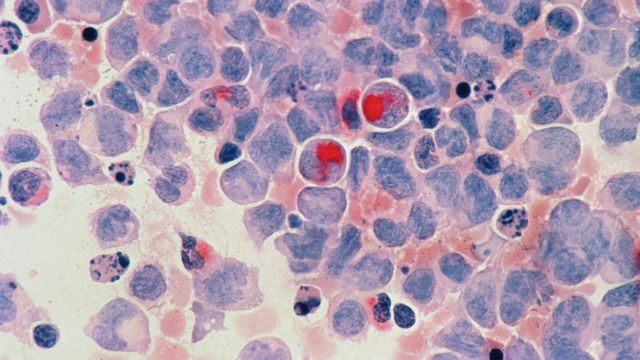 Microscopic view of acute myelocytic leukemia cells. 