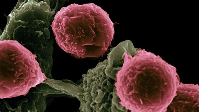 Microscopic view of cancer cells interacting with immune system cells. 