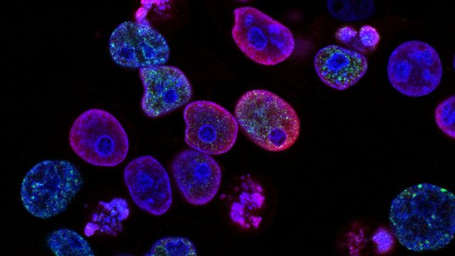 Fluorescence microscopy image displaying cancer cells and nuclei. 