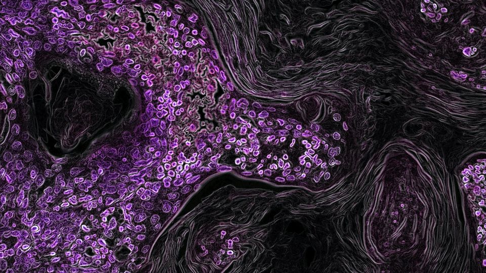 A microscopy image of pre-cancerous cells invading normal tissues.