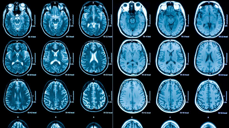 MRI Resource Maps Adolescent Brain Development | Technology Networks