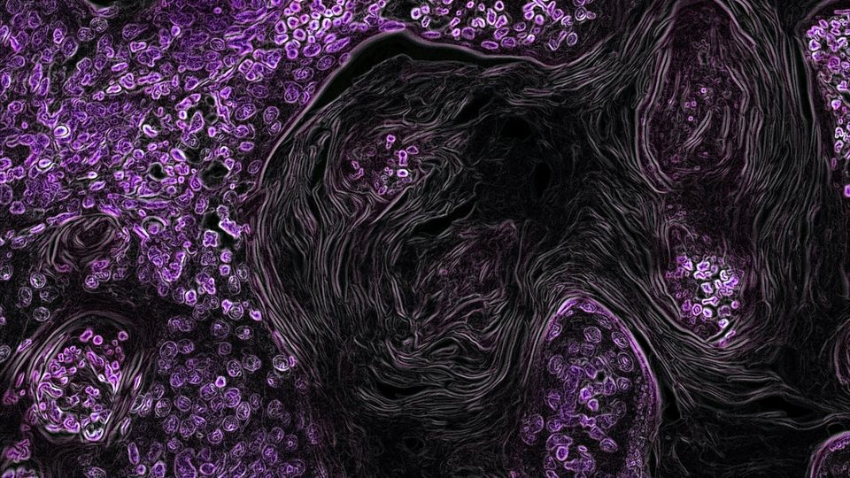 RPT04402 Shows Promise in Lung and Uterine Cancer | Technology Networks