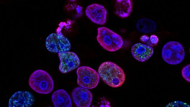 How Lung Cancer Cells Resist Ferroptosis | Technology Networks